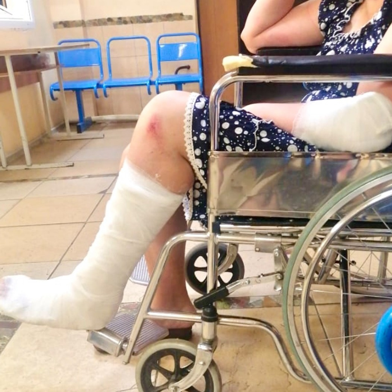 Natacha has a displaced fracture